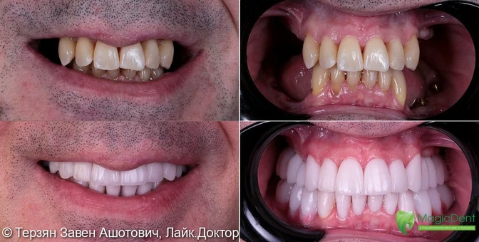 Имплантация зубов до